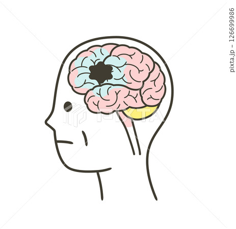 脳血管性認知症によって損傷を受ける脳の部分のイラスト 126699986