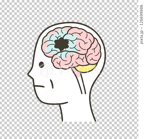 Illustration of parts of the brain damaged by vascular dementia Illustration of parts of the brain damaged by vascular dementia 126699986