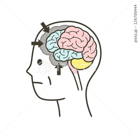 前頭側頭型認知症によって損傷を受ける脳の部分のイラスト 126700444