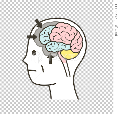 前頭側頭型認知症によって損傷を受ける脳の部分のイラスト 126700444