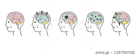 高齢者が認知症によって損傷を受ける脳の部分とその名称のイラストのセット 高齢者が認知症によって損傷を受ける脳の部分とその名称のイラストのセット 126700708