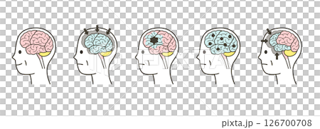 高齢者が認知症によって損傷を受ける脳の部分とその名称のイラストのセット 高齢者が認知症によって損傷を受ける脳の部分とその名称のイラストのセット 126700708