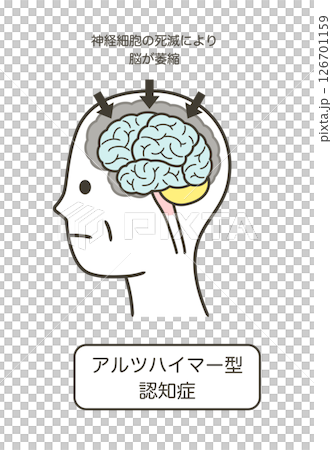 一組因阿茲海默症而受損的大腦部位及其名稱的插圖 126701159