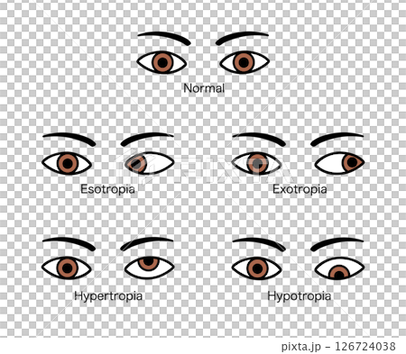斜視の種類（内斜視、外斜視、上斜視、下斜視）のイラスト 126724038