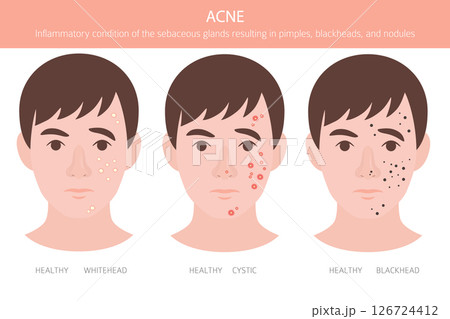 Acne skin condition. Skin diseases. Medical infographic design 126724412