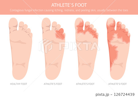 Athlete`s foot. Tinea pedis skin condition. Skin diseases. Medical infographic design 126724439