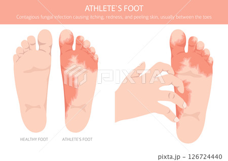 Athlete`s foot. Tinea pedis skin condition. Skin diseases. Medical infographic design Athlete`s foot. Tinea pedis skin condition. Skin diseases. Medical infographic design 126724440