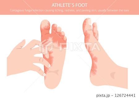 Athlete`s foot. Tinea pedis skin condition. Skin diseases. Medical infographic design 126724441