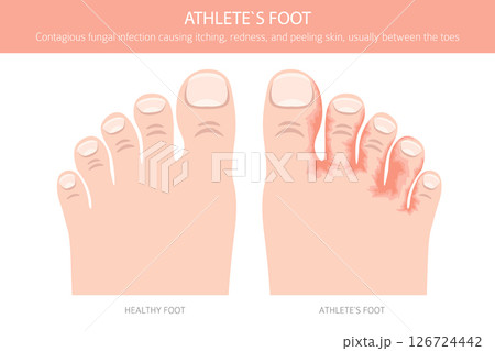Athlete`s foot. Tinea pedis skin condition. Skin diseases. Medical infographic design 126724442
