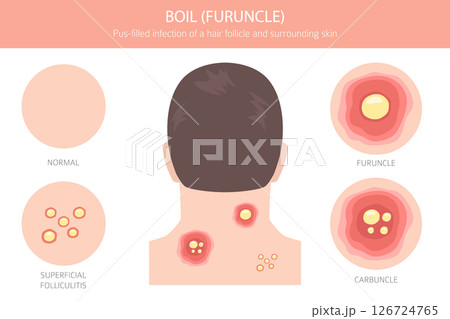 Boil, Furuncle, carbuncle. Skin diseases. Medical infographic design 126724765