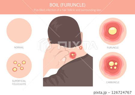 Boil, Furuncle, carbuncle. Skin diseases. Medical infographic design 126724767