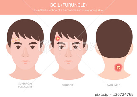Boil, Furuncle, carbuncle. Skin diseases. Medical infographic design 126724769