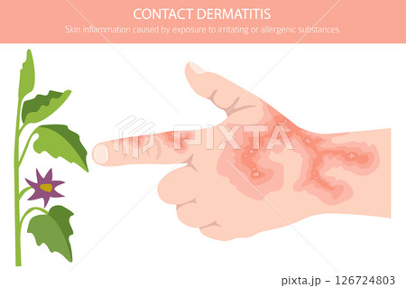 Contact dermatitis. Skin diseases. Medical infographic design 126724803