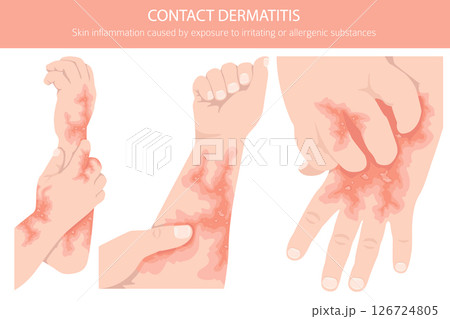 Contact dermatitis. Skin diseases. Medical infographic design Contact dermatitis. Skin diseases. Medical infographic design 126724805