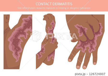 Contact dermatitis. Skin diseases. Medical infographic design 126724807