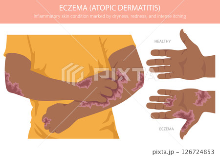 Eczema. Atopic dermatitis. Skin diseases. Medical infographic design. Vector illustration Eczema. Atopic dermatitis. Skin diseases. Medical infographic design. Vector illustration 126724853