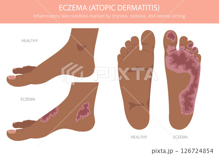 Eczema. Atopic dermatitis. Skin diseases. Medical infographic design. Vector illustration Eczema. Atopic dermatitis. Skin diseases. Medical infographic design. Vector illustration 126724854