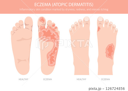 Eczema. Atopic dermatitis. Skin diseases. Medical infographic design 126724856