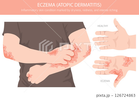 Eczema. Atopic dermatitis. Skin diseases. Medical infographic design 126724863