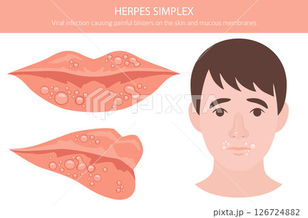 Herpes Simplex. Skin diseases. Medical infographic design Herpes Simplex. Skin diseases. Medical infographic design 126724882