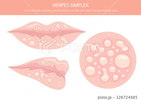 Herpes Simplex. Skin diseases. Medical infographic design 126724885