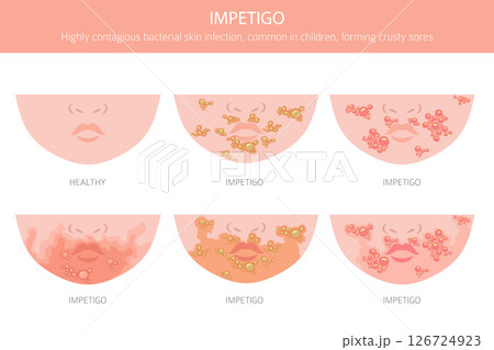 Impetigo. Skin diseases. Medical infographic design 126724923