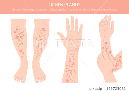 Lichen Planus. Skin diseases. Medical infographic design 126725081
