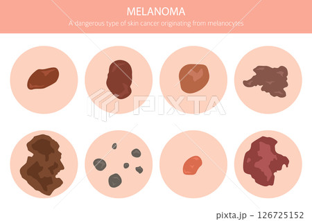 Melanoma. Skin diseases. Medical infographic design Melanoma. Skin diseases. Medical infographic design 126725152