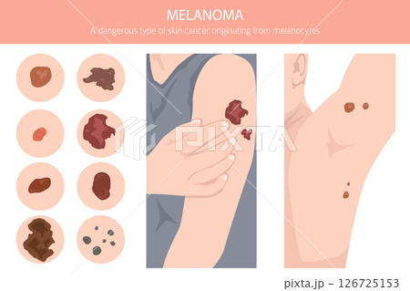 Melanoma. Skin diseases. Medical infographic design Melanoma. Skin diseases. Medical infographic design 126725153