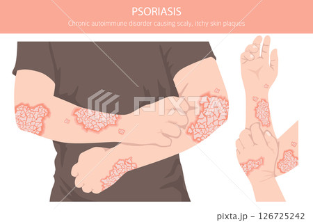 Psoriasis. Skin diseases. Medical infographic design Psoriasis. Skin diseases. Medical infographic design 126725242
