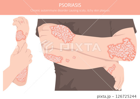 Psoriasis. Skin diseases. Medical infographic design 126725244