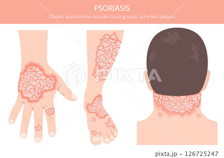 Psoriasis. Skin diseases. Medical infographic design Psoriasis. Skin diseases. Medical infographic design 126725247