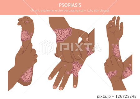 Psoriasis. Skin diseases. Medical infographic design 126725248