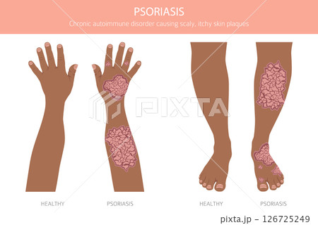 Psoriasis. Skin diseases. Medical infographic design 126725249
