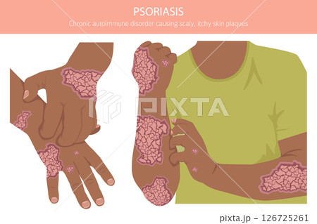 Psoriasis. Skin diseases. Medical infographic design 126725261
