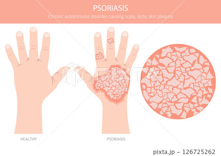 Psoriasis. Skin diseases. Medical infographic design 126725262