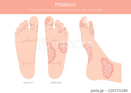 Psoriasis. Skin diseases. Medical infographic design Psoriasis. Skin diseases. Medical infographic design 126725266