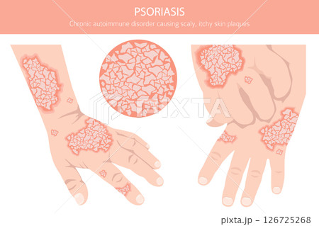 Psoriasis. Skin diseases. Medical infographic design 126725268