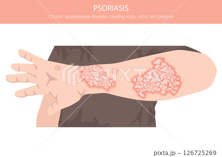Psoriasis. Skin diseases. Medical infographic design 126725269