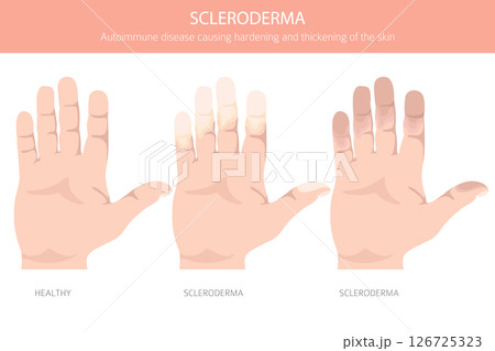 Scleroderma. Skin diseases. Medical infographic design Scleroderma. Skin diseases. Medical infographic design 126725323
