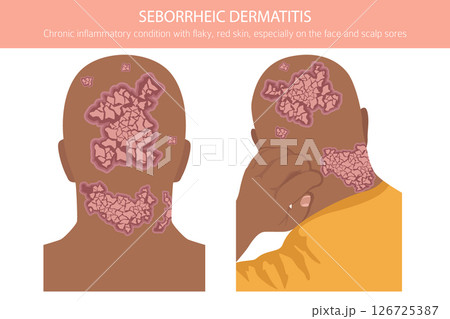 Seborrheic dermatitis. Skin diseases. Medical infographic design Seborrheic dermatitis. Skin diseases. Medical infographic design 126725387