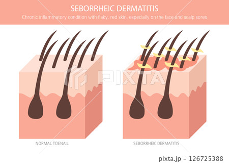 Seborrheic dermatitis. Skin diseases. Medical infographic design Seborrheic dermatitis. Skin diseases. Medical infographic design 126725388