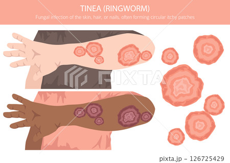 Tinea. Ringworm. Skin diseases. Medical infographic design 126725429