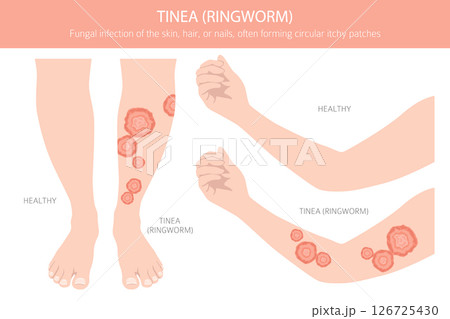 Tinea. Ringworm. Skin diseases. Medical infographic design 126725430