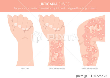 Urticaria. Hives. Skin diseases. Medical infographic design Urticaria. Hives. Skin diseases. Medical infographic design 126725476