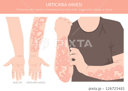 Urticaria. Hives. Skin diseases. Medical infographic design Urticaria. Hives. Skin diseases. Medical infographic design 126725481
