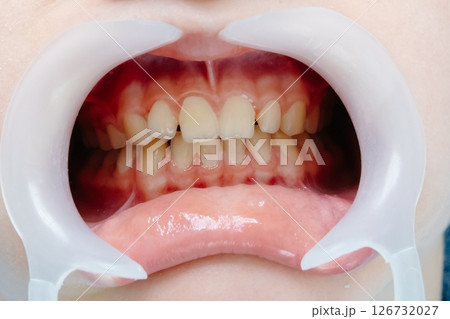 Open mouth showing teeth during dental checkup Open mouth showing teeth during dental checkup 126732027