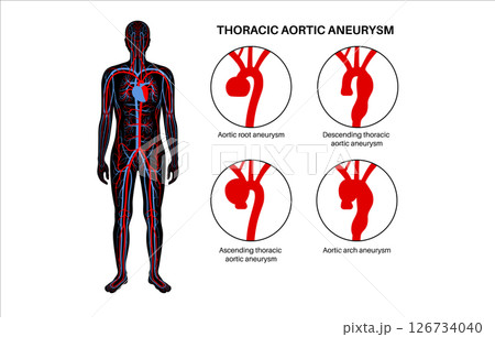 Thoracic aortic aneurysm 126734040