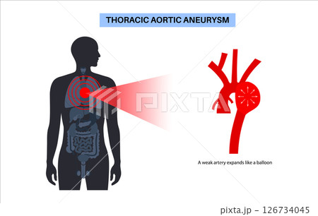 Thoracic aortic aneurysm 126734045
