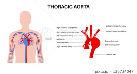 Thoracic aortic aneurysm 126734047